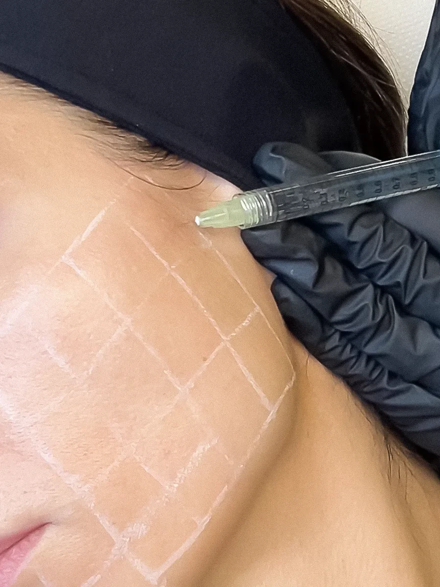Tratament Skin Booster Volite la AMOO Klinik București