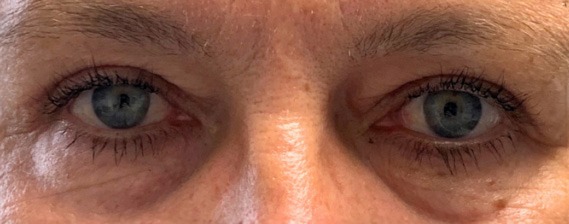 Pacient dupa de interventie blafaroplastie superioara doctor Pantazi AMOO Klinik