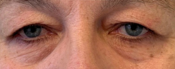 Pacient inainte de interventie blafaroplastie superioara doctor Pantazi AMOO Klinik