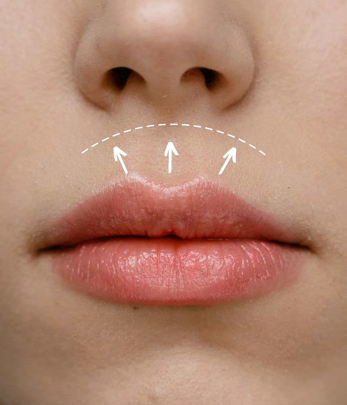 Lip lift: ridicarea buzei superioare la AMOO Klinik București