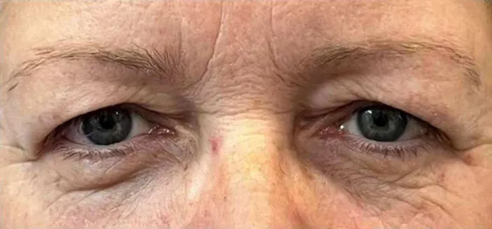 Blefaroplastie Dr Fabian Gurau - înainte de procedură