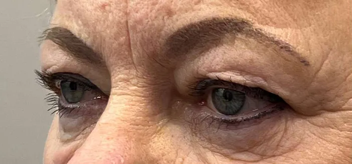 Blefaroplastie dr Andrei Pantazi - înainte de procedură
