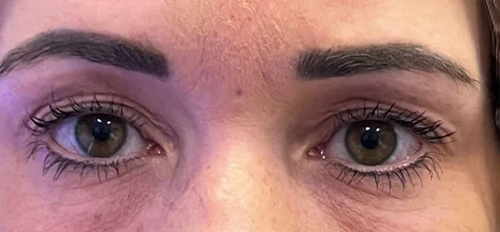 Blefaroplastie dr Andrei Pantazi - înainte de procedură
