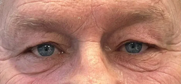 Blefaroplastie dr Andrei Pantazi - înainte de procedură
