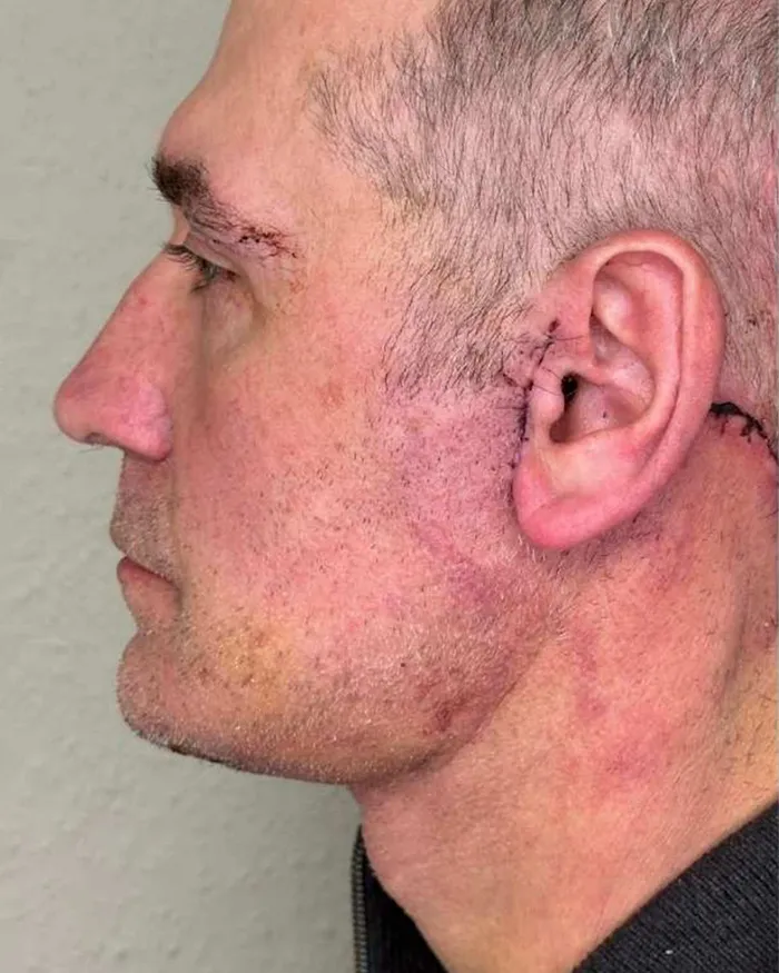 Deep Plane Face - Necklift dr Andrei Pantazi - după procedură