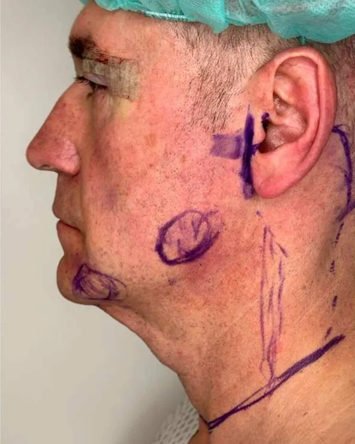 Deep Plane Face - Necklift dr Andrei Pantazi - înainte de procedură
