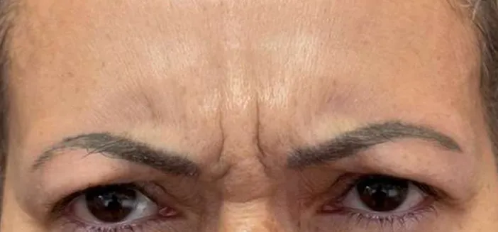 Tratament botox dr Alexandru Banica Amoo Klinik - înainte de procedură