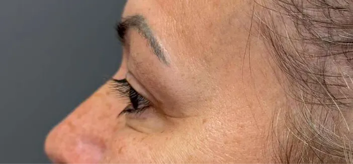 Tratament botox dr Alexandru Banica Amoo Klinik - după procedură