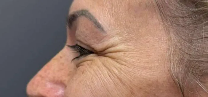 Tratament botox dr Alexandru Banica Amoo Klinik - înainte de procedură