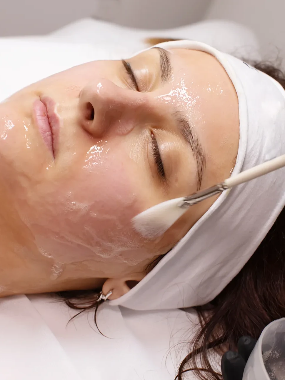 Aplicarea unui peeling chimic pe față, cu pensula, la AMOO Klinik
