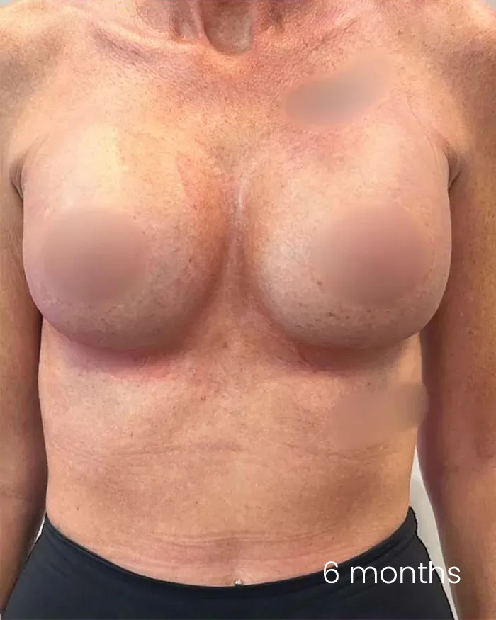 Augumentare mamara cu implant dr Andrei Pantazi - după procedură