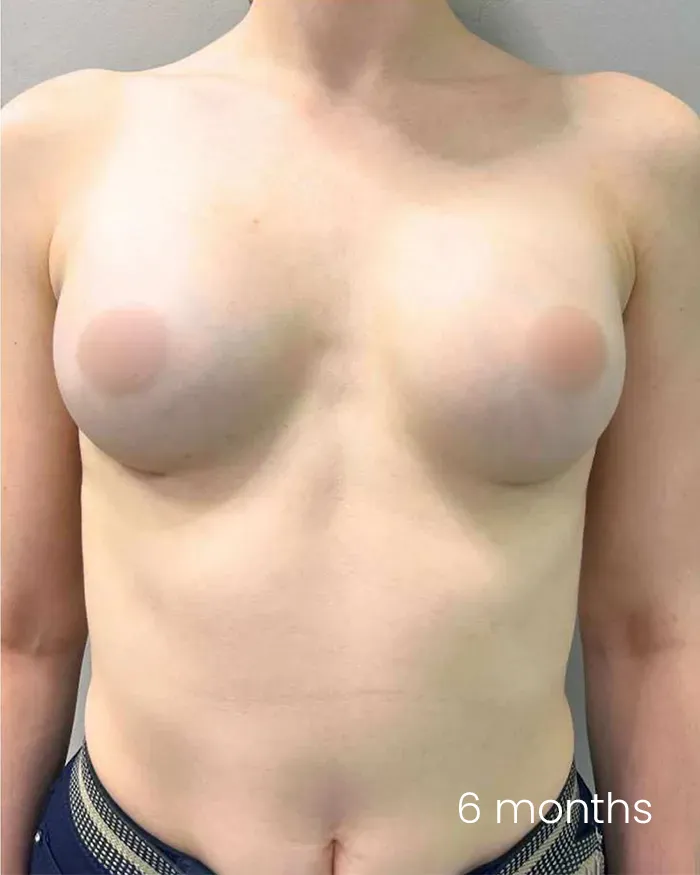 Augmentare mamară cu implant dr Michael Pantazi - dupa procedură