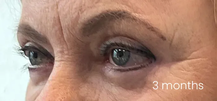 Blefaroplastie dr Andrei Pantazi - după procedură