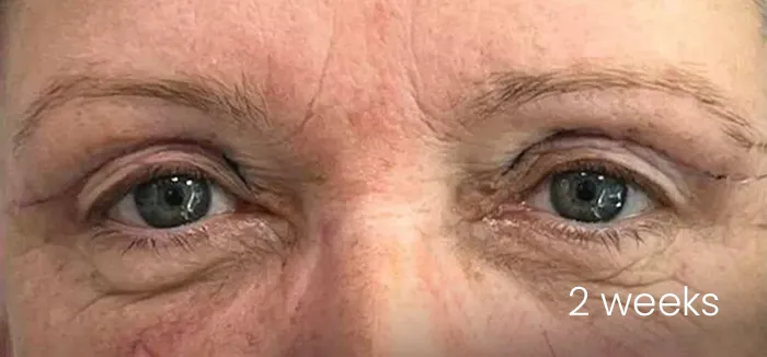 Blefaroplastie Dr Fabian Gurau - după procedură