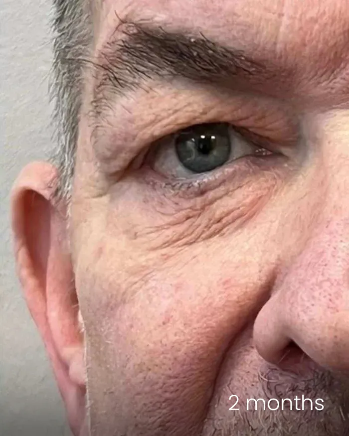 Blefaroplastie dr Michael Pantazi - după procedură