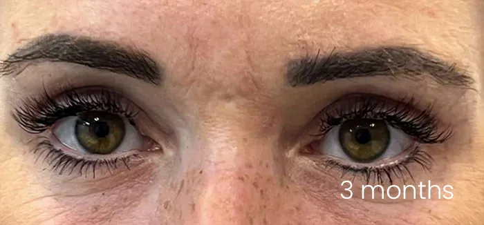 Blefaroplastie dr Andrei Pantazi - după procedură