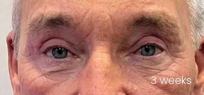 Blefaroplastie dr Michael Pantazi - după procedură