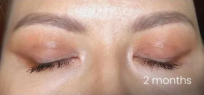 Blefaroplastie dr Michael Pantazi - după procedură
