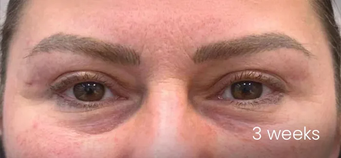Blefaroplastie dr Michael Pantazi - după procedură