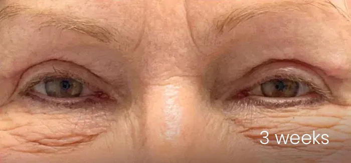 Blefaroplastie dr Michael Pantazi - după procedură