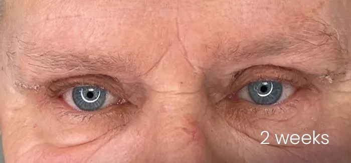 Blefaroplastie dr Andrei Pantazi - după procedură