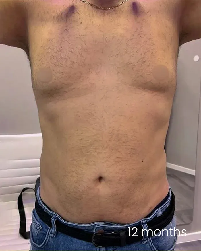 Body tite Amoo Klinik dr Michael Pantazi - dupa procedura