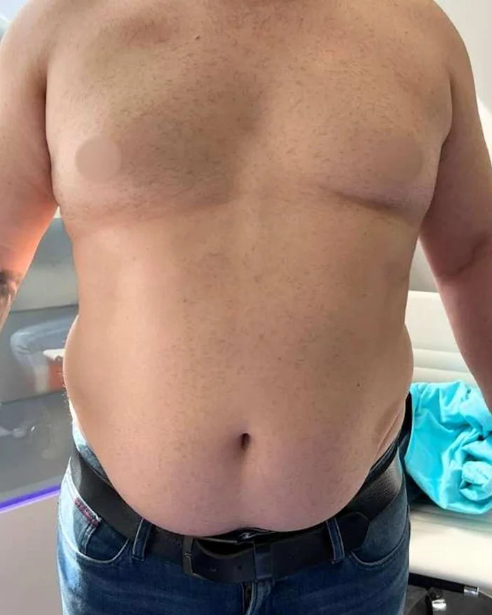 Body tite Amoo Klinik dr Michael Pantazi - inainte de procedura