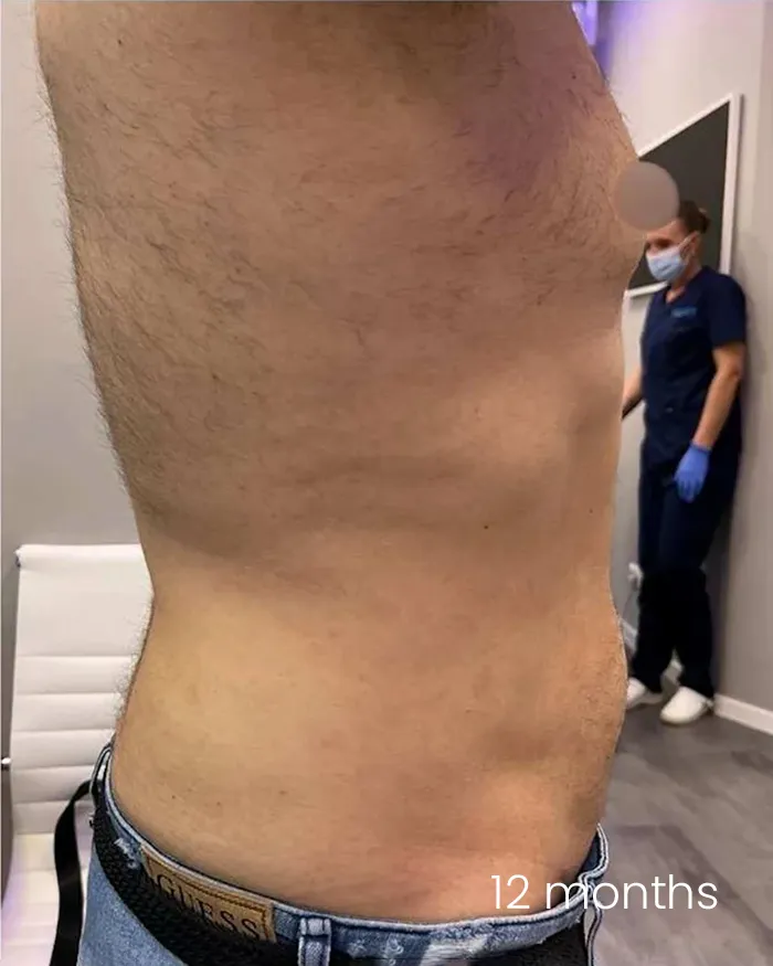 Body tite Amoo Klinik dr Michael Pantazi - dupa procedura