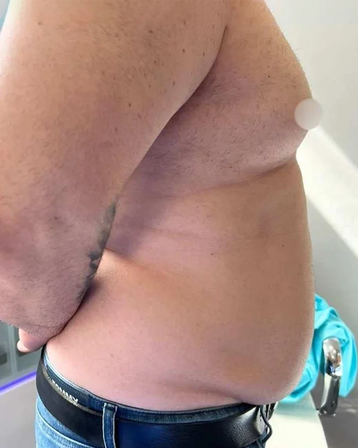 Body tite Amoo Klinik dr Michael Pantazi - inainte de procedura