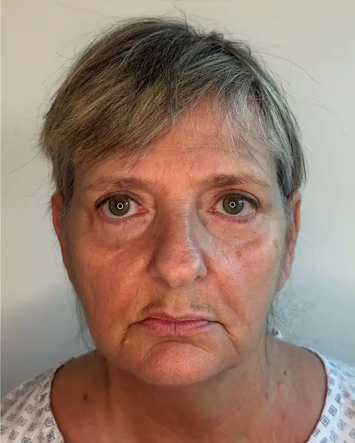 Deep Plane Facelift Amoo Klinik - inainte de procedură
