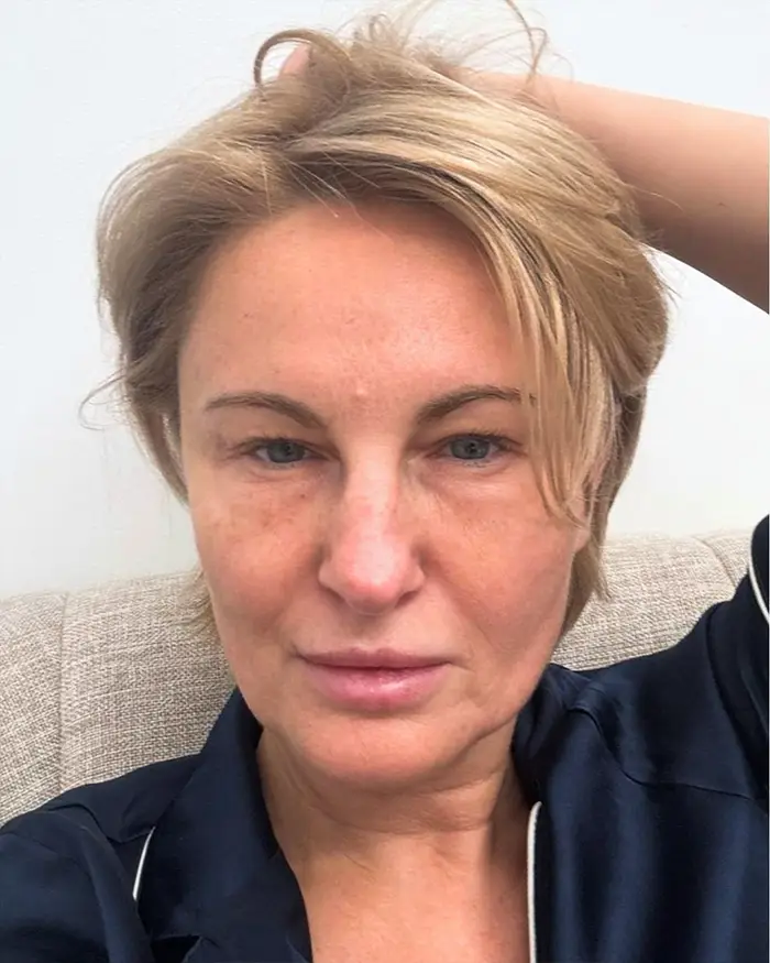 Deep Plane Facelift Amoo Klinik - inainte de procedură