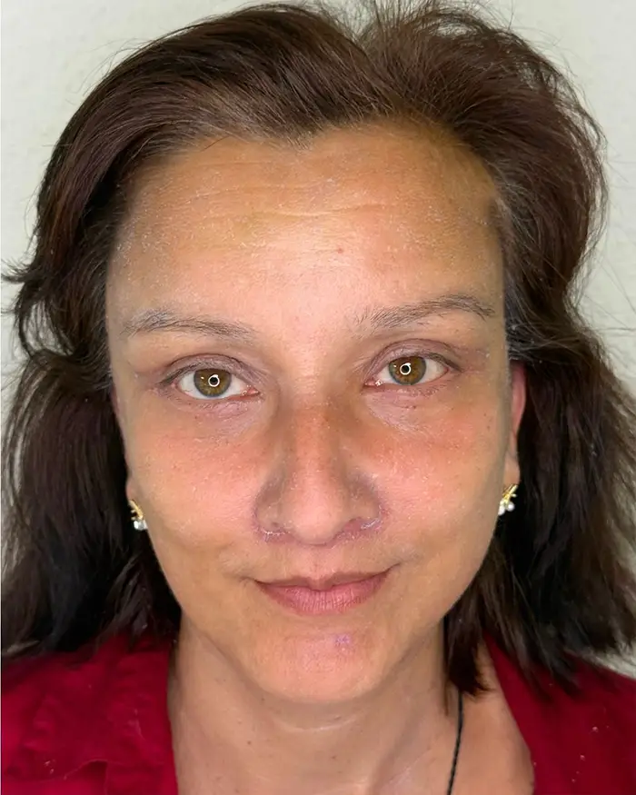 Deep Plane Facelift Amoo Klinik - dupa procedură