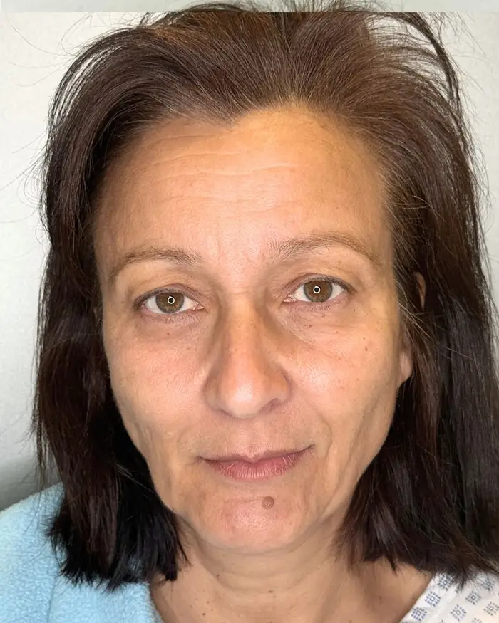Deep Plane Facelift Amoo Klinik - inainte de procedură