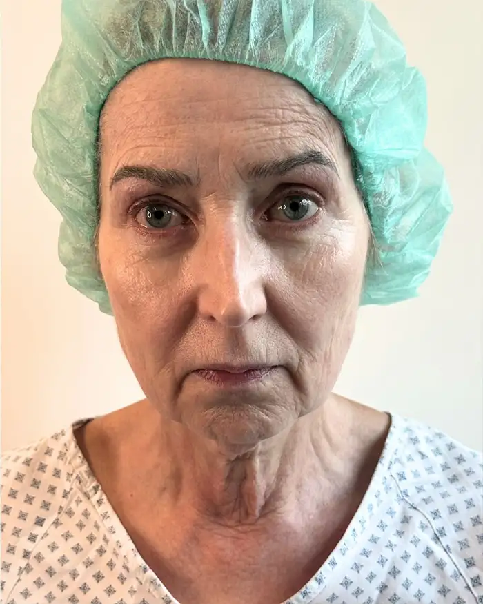 Deep Plane Facelift Amoo Klinik - inainte de procedură