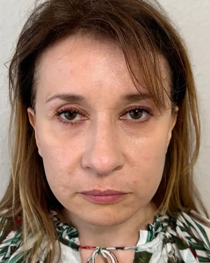 Deep Plane Facelift Amoo Klinik - dupa procedură