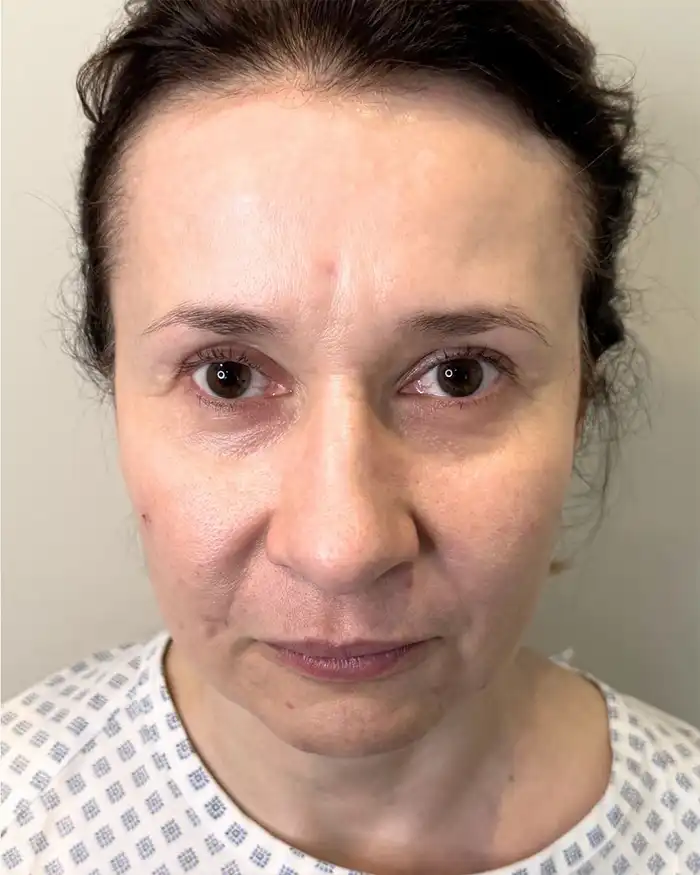 Deep Plane Facelift Amoo Klinik - inainte de procedură