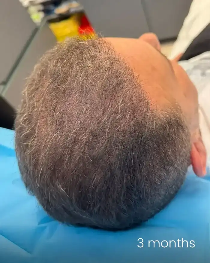PRP scalp AMOO Klinik - dupa tratament