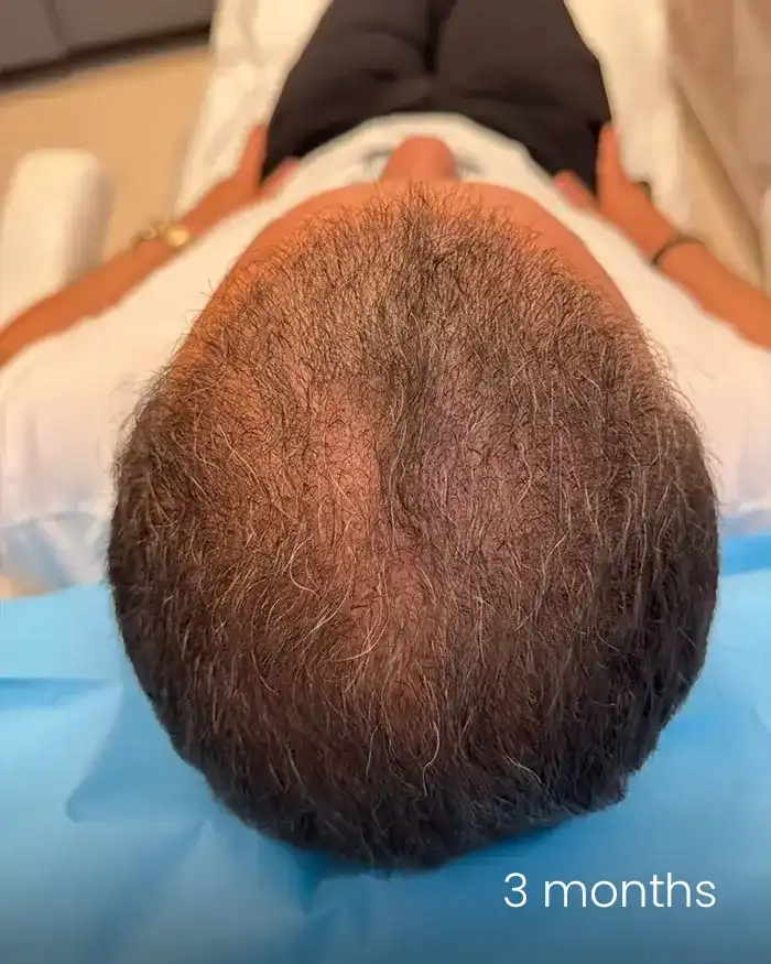 PRP scalp AMOO Klinik - dupa tratament