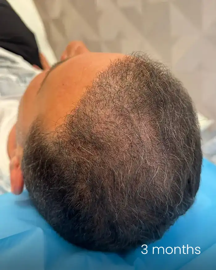 PRP scalp AMOO Klinik - dupa tratament