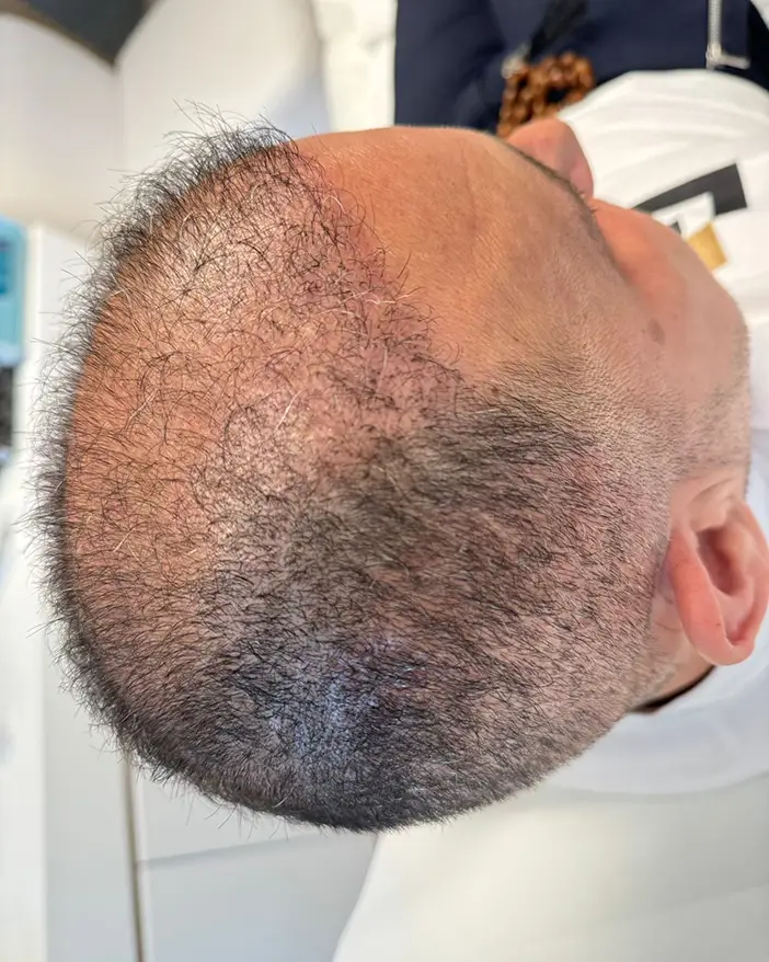 PRP scalp AMOO Klinik - inainte de tratamet