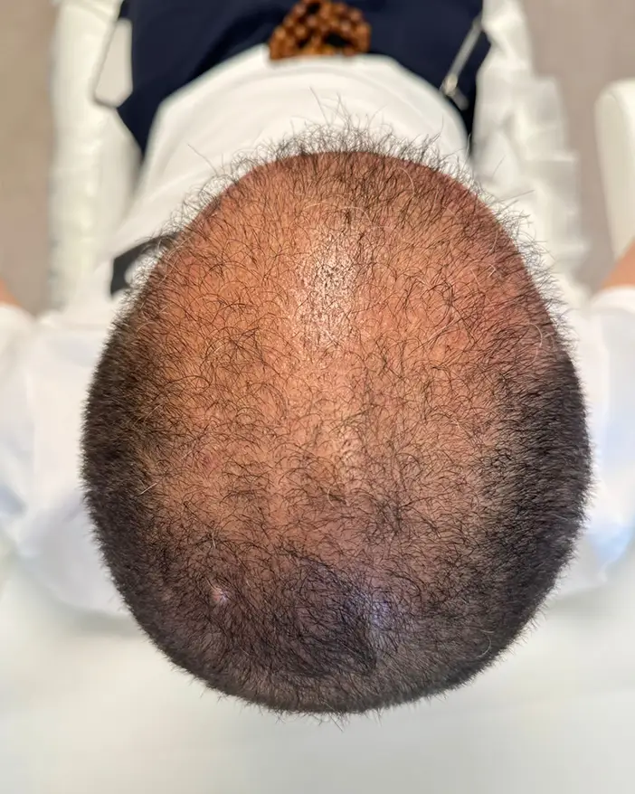 PRP scalp AMOO Klinik - inainte de tratament