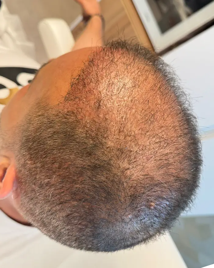 PRP scalp AMOO Klinik - inainte de tratament