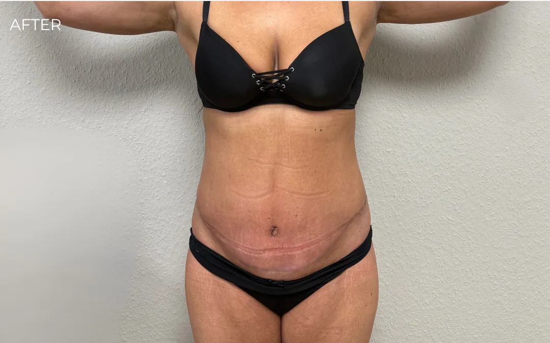 Abdominoplastie Dr. Michael Pantazi, AMOO Klinik - după procedură