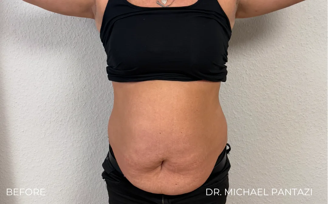 Abdominoplastie Dr. Michael Pantazi, AMOO Klinik - înainte de procedură