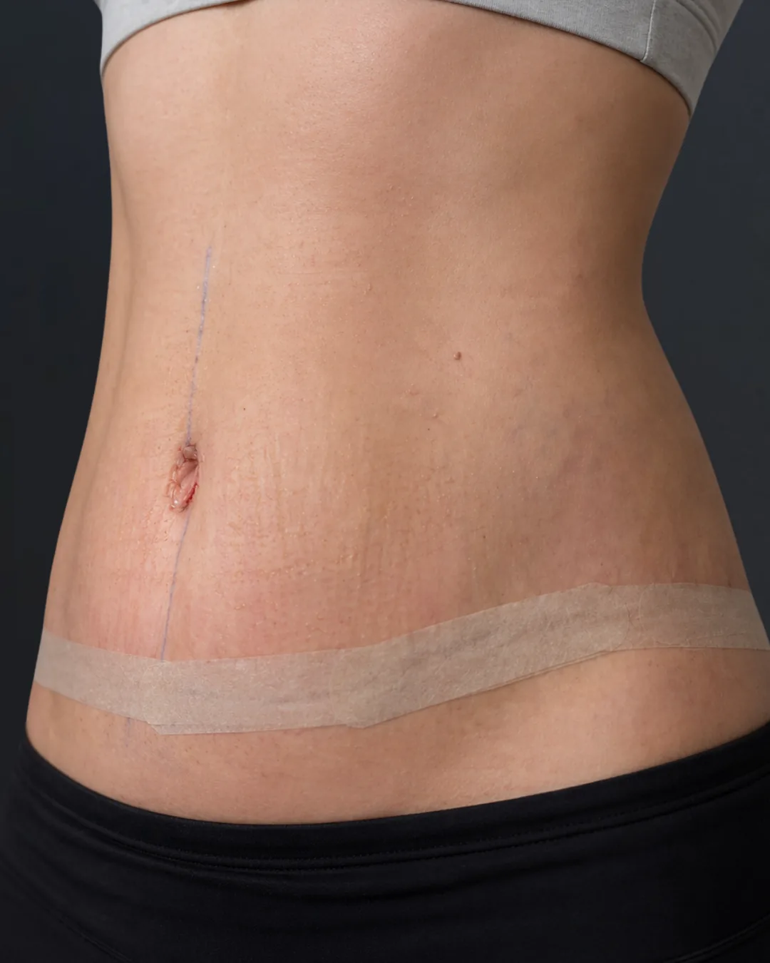 Abdominoplastie, AMOO Klinik - după procedură