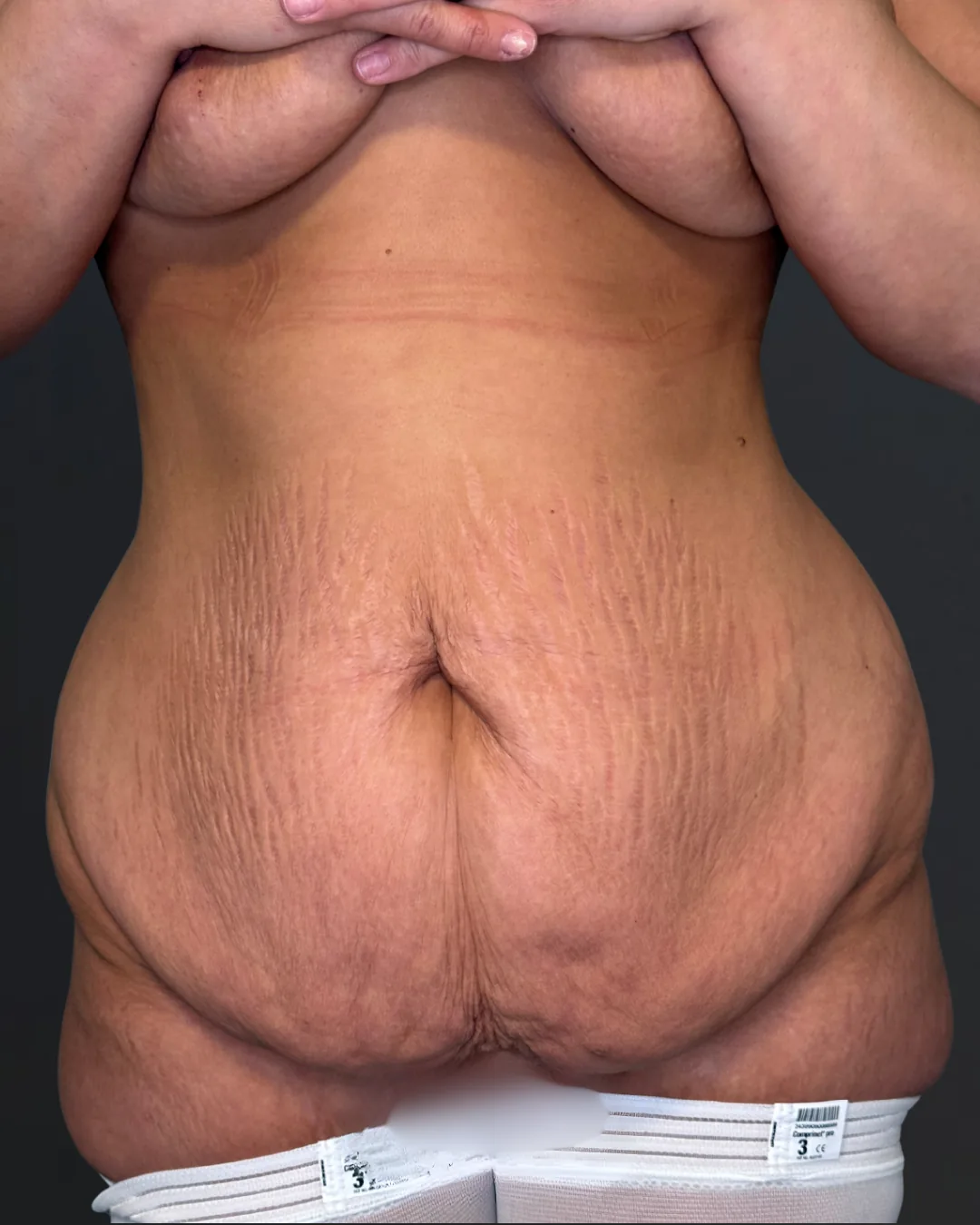 Abdominoplastie, AMOO Klinik - înainte de procedură