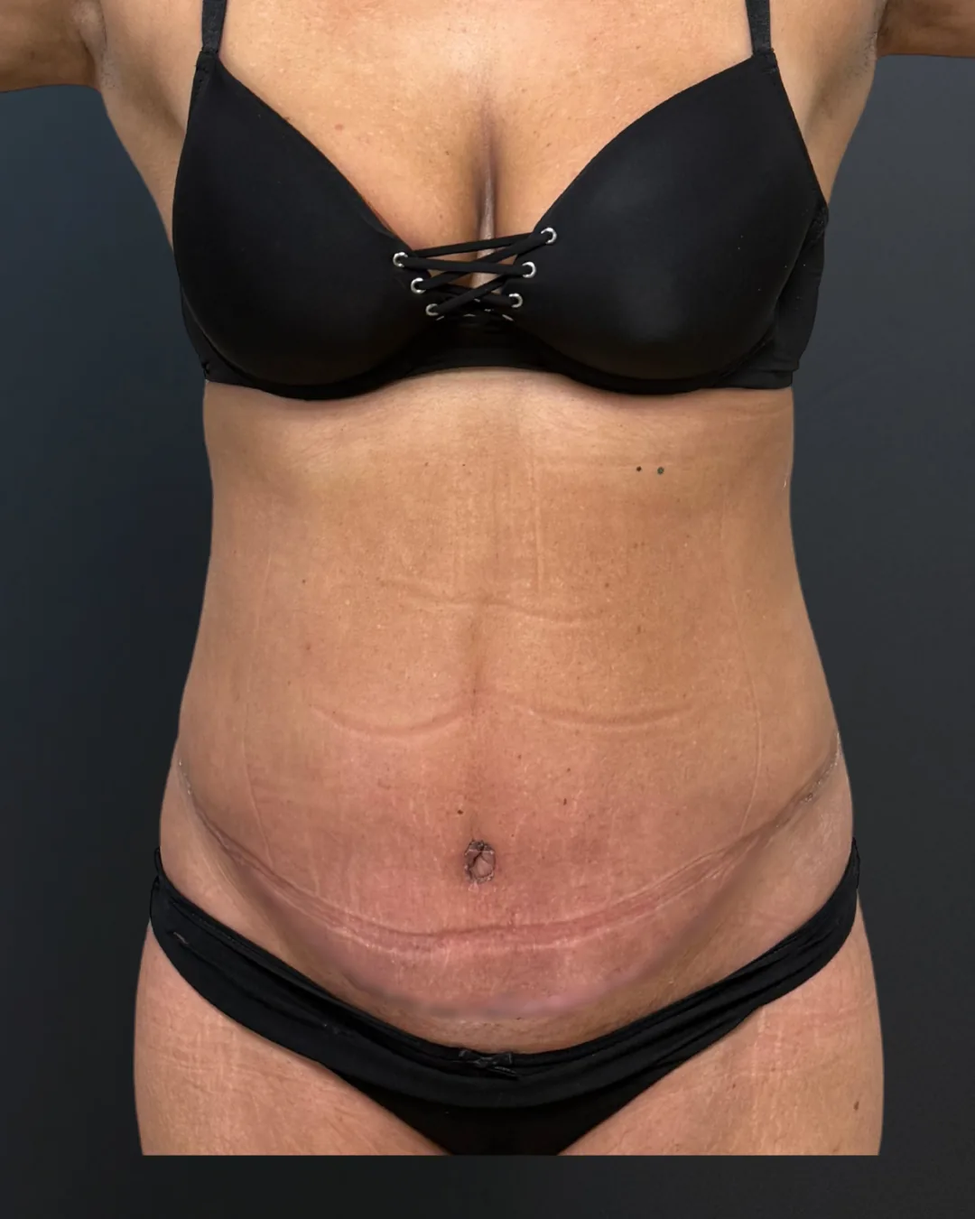 Abdominoplastie, AMOO Klinik - după procedură