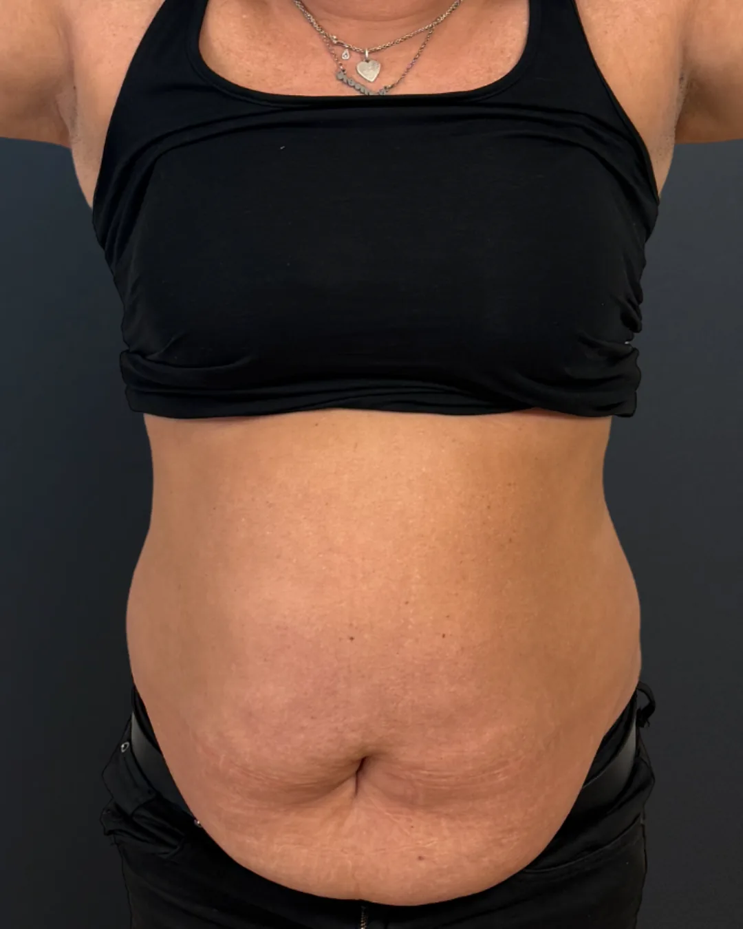 Abdominoplastie, AMOO Klinik - înainte de procedură