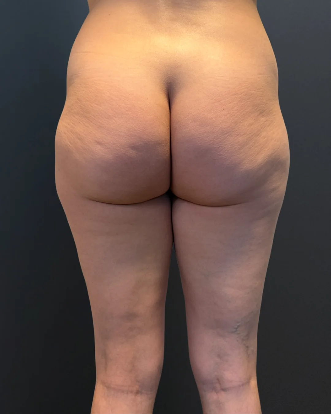 BBL (Brazilian Butt Lift), AMOO Klinik - înainte de procedură